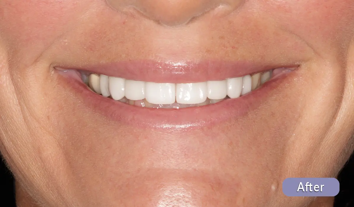 cosmetic-dentistry-before-after-01-after After cosmetic dental treatment, actual patient