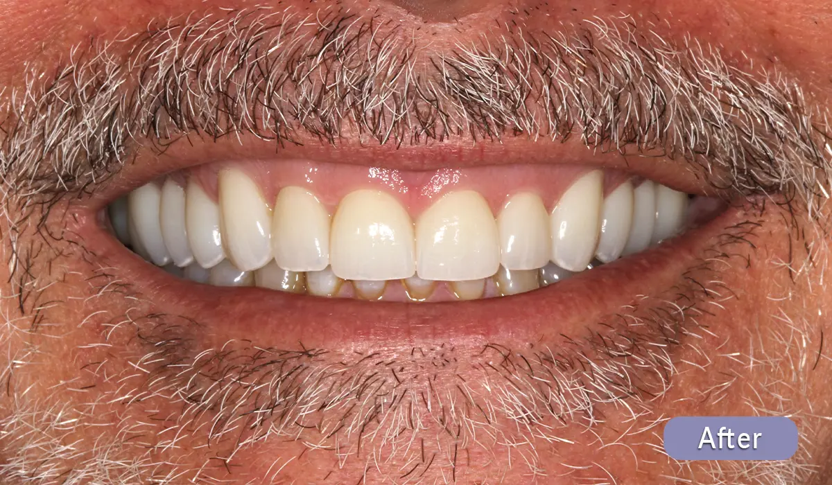 cosmetic-dentistry-before-after-02-after After cosmetic dental treatment, actual patient