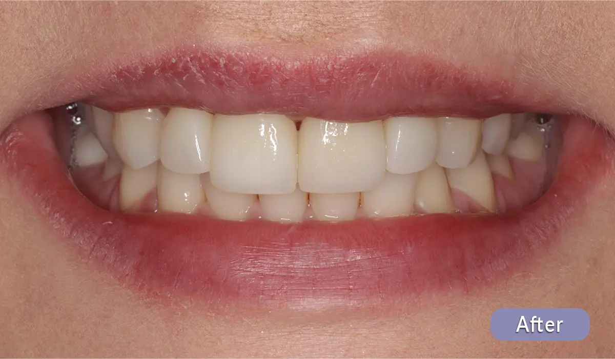cosmetic-dentistry-before-after-03-after After cosmetic dental treatment, actual patient